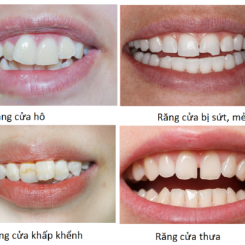 TƯ VẤN LÀM RĂNG SỨ MIỄN PHÍ TẠI QUẬN 2 – NHA KHOA MẶT TRỜI