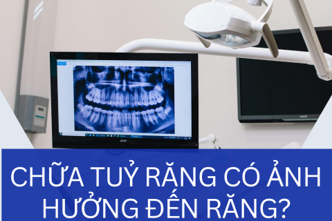 Chữa tủy răng có ảnh hưởng đến răng không? – Nha khoa Mặt Trời Quận 2