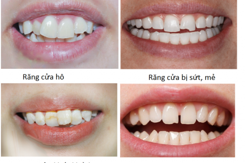 TƯ VẤN LÀM RĂNG SỨ MIỄN PHÍ TẠI QUẬN 2 – NHA KHOA MẶT TRỜI